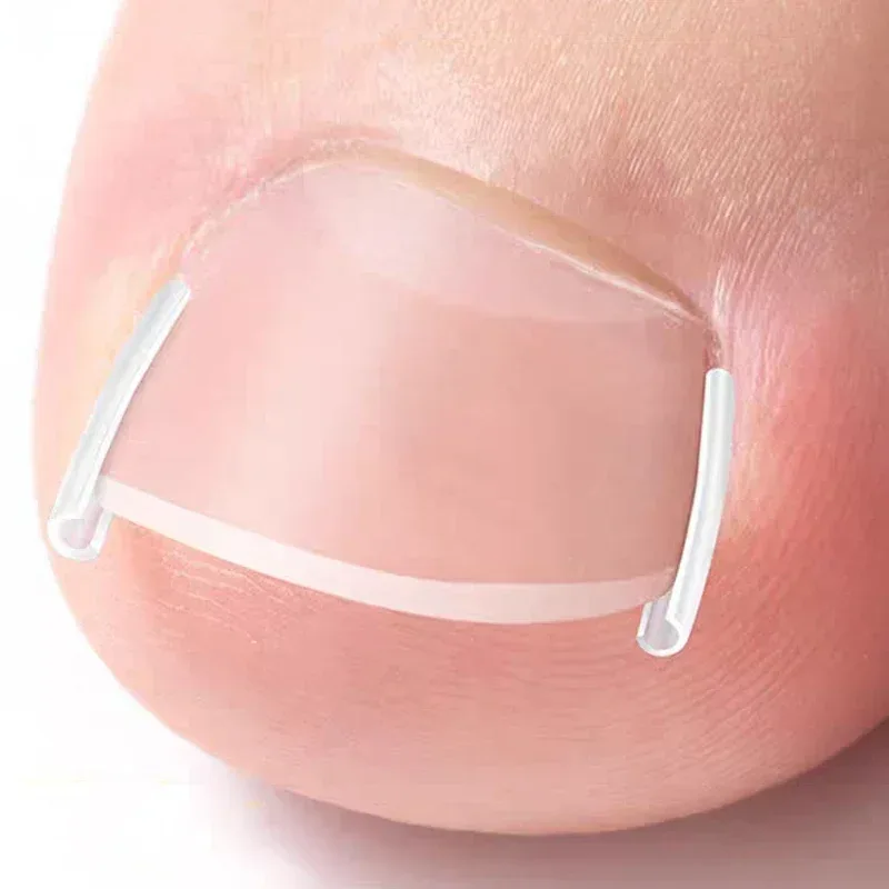 1-10 Box Elastic C-shaped Tube Padding Treatment Foot Care Invisible Groove Straightening Clip Ingrown Toenail Corrector Tools