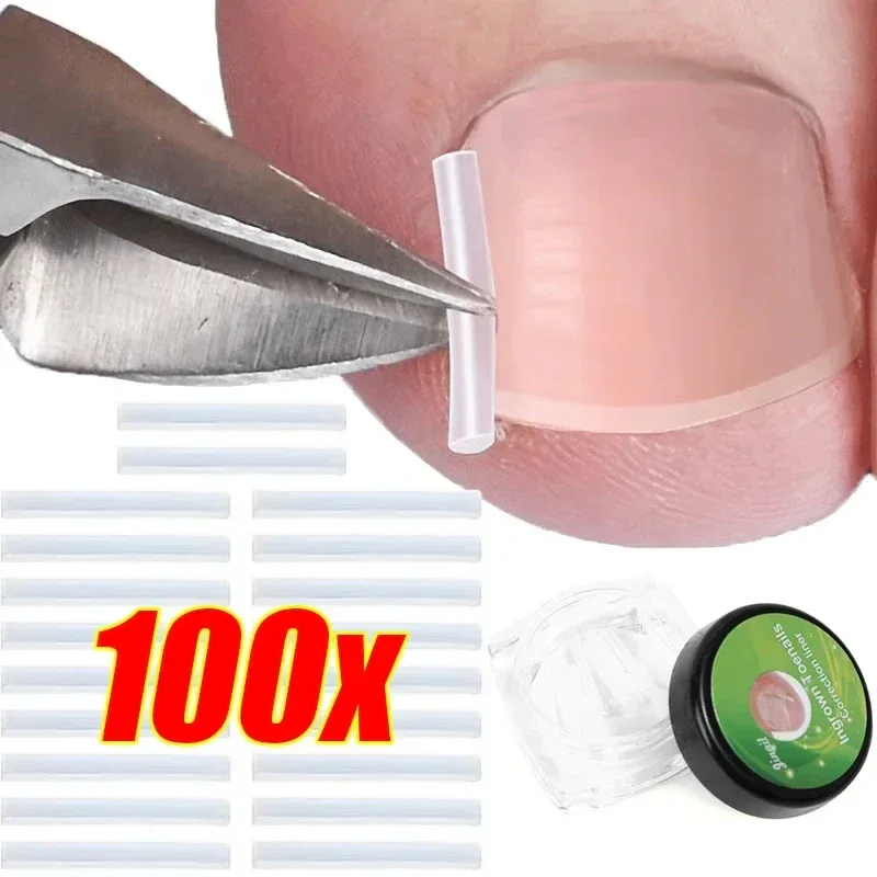 1-10 Box Elastic C-shaped Tube Padding Treatment Foot Care Invisible Groove Straightening Clip Ingrown Toenail Corrector Tools