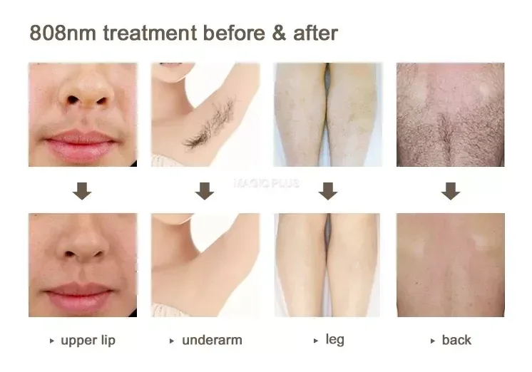 4000w High Power Diode Laser Hair Removal Cold Permanent Epilator Hair Removal Device Diode Laser Remove Hair Machine